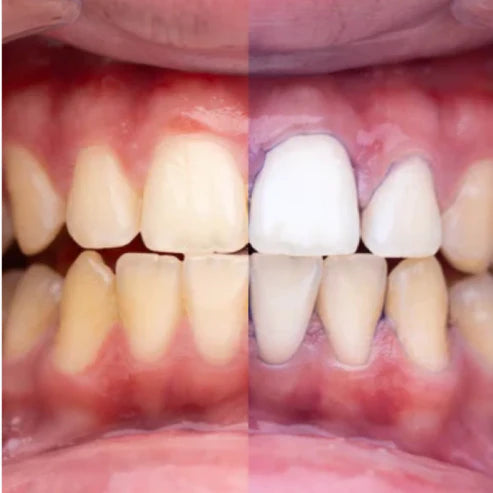 Blanqueador Dental V34 - Dentaliss™