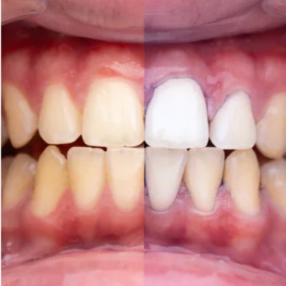 Blanqueador Dental V34 - Dentaliss™